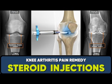 क्या घुटने में दर्द के लिए इंजेक्शन लगवाना चाहिए? Are knee injections good for knee pain?